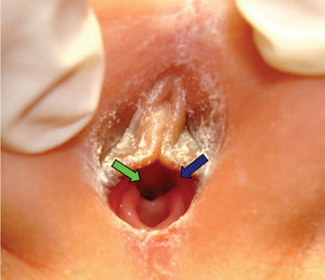 Genitales externos con meato uretral amplio (flecha azul), desplazado y deformado por masa pélvica izquierda (cecoureterocele).