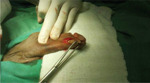 Identificación y extracción de cuerpo extraño en uretra.