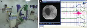 A: sala de videourodinamia. B: trazado de videourodinamia e integración de la imagen en video o estática con los hallazgos del estudio funcional.