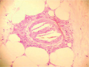 Biopsia de piel: embolia por cristales de colesterol.