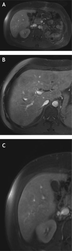 Resonancia magnética de abdomen del 28 de julio de 2014. A) Corte axial post contraste donde se observan cambios postquirúrgicos por nefrectomía radical izquierda. B y C) Cortes post contraste evidenciando múltiples lesiones focales de baja intensidad de señal en ambos lóbulos hepáticos compatibles con depósitos metastásicos.