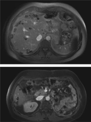 Resonancia magnética de abdomen, cortes axiales poscontraste del 2 de diciembre de 2014: cambios posquirúrgicos por nefrectomía radical izquierda. Múltiples lesiones de baja intensidad de señal en ambos lóbulos hepáticos compatibles con depósitos metastásicos, las cuales en comparación con estudio previo han disminuido de tamaño y de menor intensidad de señal de señal hallazgos compatibles con repuesta al tratamiento según criterios MASS.