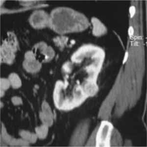 Tomografía de abdomen y pelvis contrastada, corte coronal. Masa hipervascular en el tercio medio del riñón izquierdo de 3,2 cm con < 50% de componente exofítico. Esta lesión se localiza a aproximadamente 8 mm del seno renal y en la mitad de las líneas polares. Puntuación aproximada de 7, clasificándola como lesión de complejidad moderada.