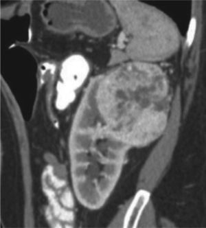 Tomografía de abdomen y pelvis contrastada, corte coronal. Masa hipervascular en el polo superior del riñón izquierdo de aproximadamente 5,8 cm, con un componente < 50% de componente exofítico, localizada a 3 mm del seno renal, esta lesión cruza la línea polar superior. Sus características le otorgan un puntaje en nefrometría de 10 puntos, clasificándola como una lesión de alta complejidad.