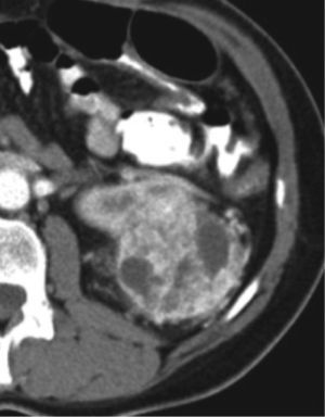 Tomografía de abdomen y pelvis contrastada, corte axial. Masa de densidad heterogénea, hipervascular con áreas centrales hipodensas, de aproximadamente 5,2 cm localizada en el polo superior del riñón derecho, de aspecto neoplásico, asociado a alteración en la densidad de la grasa perirrenal por infiltración neoplásica.