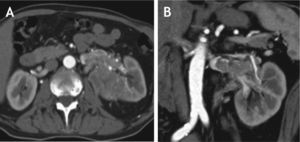 Tomografía de abdomen total contrastada, corte coronal y axial. Se evidencia imagen hipodensa endoluminal en la vena renal izquierda, que corresponde a trombo, clasificado como Nivel I, en un paciente con carcinoma de células renales.