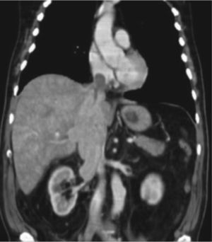 Tomografía de abdomen y pelvis contrastada, corte coronal. Extensa trombosis que compromete la vena renal y la vena cava inferior por encima del diafragma, clasificado como Nivel IV en un paciente con carcinoma de células renales.