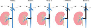 Niveles de compromiso por trombosis de la vena renal. Autoría propia.