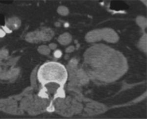 Tomografía de abdomen y pelvis contrastada, corte axial. Lesión de aspecto neoplásico localizada en el polo superior del riñón derecho asociado a adenomegalias perirrenales con diámetros en eje corto mayores a 15 mm, sospechosas de compromiso neoplásico.