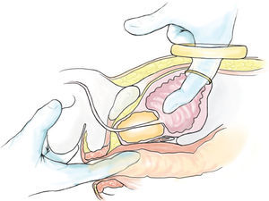 Representación esquemática de la técnica dedo asistida empleada en el procedimiento. Al quitar el puerto se puede acceder hasta la próstata a través de los anillos colocados en la incisión suprapúbica.