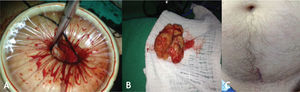 A: Extracción de la próstata a través de la incisión suprapúbica. B: Espécimen extraído. C: Incisión al final del procedimiento.