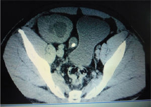 Corte axial de Urotac con presencia de hidroureteronefrosis grado III del riñón trasplantado con múltiples litos ureterales.