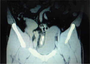 Corte coronal de Urotac mostrando múltiples cálculos ureterales y dilatación piélica y ureteral del riñón trasplantado.