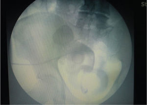 Imagen fluoroscópica de la colocación de nefrostomía percutánea del riñón trasplantado, medio de contraste con mínimo paso a vejiga y presencia de múltiples litos ureterales.