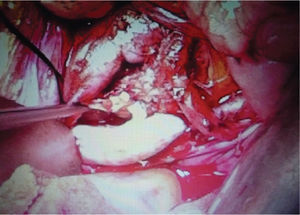 Procedimiento quirúrgico abierto, se identifica dilatación tanto piélica como ureteral del riñón trasplantado.