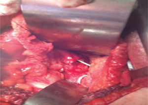 Imagen cirugía abierta identificándose pelvis del riñón trasplantado abierta y uréter nativo derecho con catéter ureteral luego de nefrectomía del riñón nativo derecho.