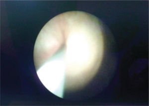 Imagen endoscópica del catéter ureteral, desde el riñón trasplantado y saliendo por el mato ureteral nativo derecho.
