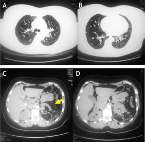 A y B (arriba): Tomografía axial de tórax. C y D (abajo): Tomografía axial de abdomen.