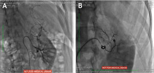 A: Vasculatura arterial renal y de angiomiolipoma gigante dependiente de polo superior. B: Conservación de vasculatura de polo inferior de riñón izquierdo.