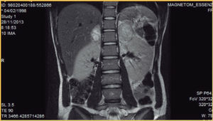 Resonancia magnética de abdomen de paciente de 15 años que evidencia masa adrenal bilateral. El estudio metabólico así como la gammagrafía con MIBG sugerían feocromocitoma bilateral.