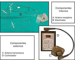 Componentes internos y externos del SARS.A: antena receptora; B: electrodos; C: antena transmisora; D: controlador.
