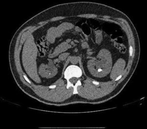 Corte axial de uro-TAC.