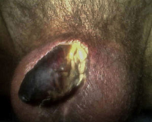Necrosis de los 2/3 distales del pene, con áreas eritematosas perilesionales.