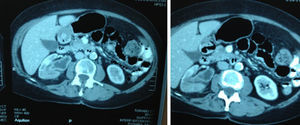 Tomografía con evidencia de carcinoma urotelial.