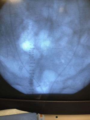 Catéteres rectos en cavidades renales visualizados por fluoroscopia.