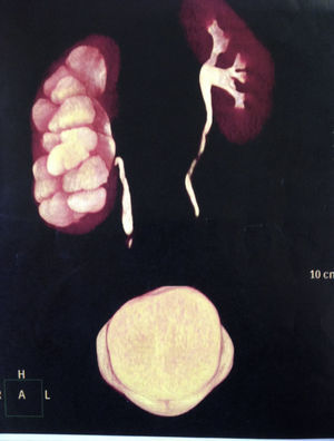 Urografía-TAC.