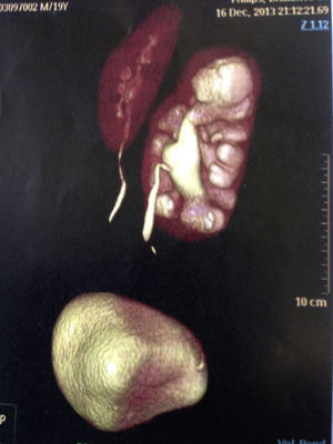 Urografía-TAC.