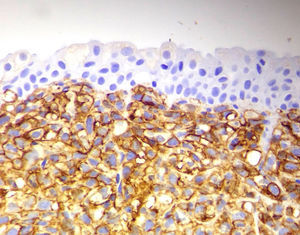 Las celulas son CD20 positivo. Confirma linfoma fenotipo B.