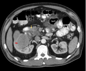 En la tomografía axial computarizada de abdomen se indica con la flecha roja una lesión sólida en el polo inferior riñón derecho. La flecha amarilla señala la raíz de mesenterio donde se evidencia lesión hipodensa mal definida.