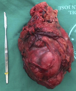 Pieza quirúrgica extraída de carcinoma renal, riñón derecho.