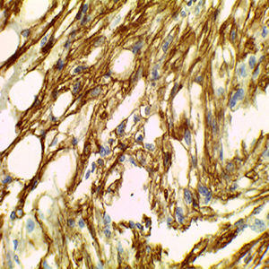 IHQ actina de músculo liso positivo en células tumorales.