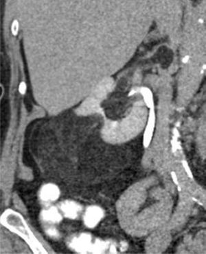 Reconstrucción coronal de TC con medio de contraste que demuestra la presencia de una lesión renal hipodensa con densidad promedio de −40 UH (AML), que infiltra la vena cava inferior.