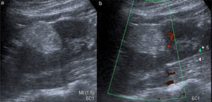US renal. a) Imagen que demuestra la presencia de una masa renal predominantemente ecogénica con sombra acústica posterior. b) La misma lesión a la valoración con Doppler poder, que demuestra ausencia de flujo intratumoral; características de un AMLC.