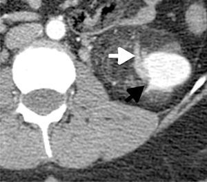 Corte axial de TC con medio de contraste. Se observa una masa en el tercio inferior del riñón izquierdo, donde se demuestra el defecto del parénquima renal (flecha blanca) y los vasos intralesionales dilatados (flecha negra) en una lesión que correspondía a AML.
