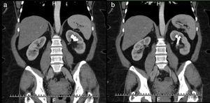 Tomografía axial de abdomen con contraste en cortes coronales que muestra cálculo coraliforme incompleto ocupando cáliz superior y medio en riñón izquierdo.
