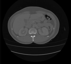 Urografía por tomografía: Lesión en cáliz superior derecho, con densidad de tejidos blandos y calcificaciones en su interior.
