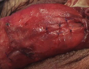 Ligadura de vena dorsal profunda y ramificaciones.