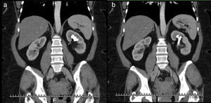 Abdominal computed axial tomography (CAT) scan with contrast in coronal slices that show an incomplete staghorn calculus occupying the upper and middle calyx of a left kidney.