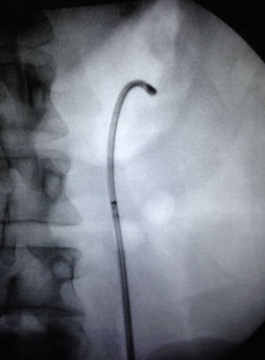 Fluoroscopic view of left kidney after RFLNL in which it shows the absence of significant residual fragments.