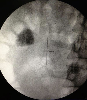 Fluoroscopic view of right kidney with evidence of an incomplete staghorn calculus of >2cm. gr5.