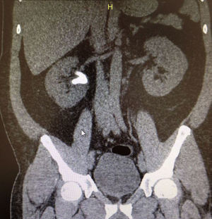 Simple abdominal CAT scan in coronal slices that show an incomplete staghorn calculus occupying renal pelvis and upper calyx in right kidney.