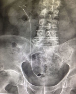 Simple abdominal X-ray with a double J catheter in position in right ureter, with no evidence of residual stoned in the renal silhouette or ureteral tract after only one surgical time.