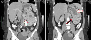 A) Tomografía abdominal contrastada corte coronal que muestra trombo en vena renal izquierda (flecha blanca). B) Necrosis en polo superior de masa renal izquierda (flecha blanca) e importante neovascularización secundaria al tumor (flecha negra).