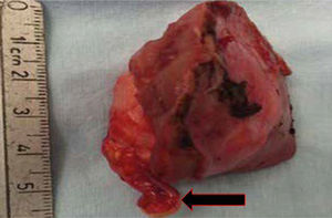 Totalidad del espécimen macroscópico de nefrectomía parcial en cuña, evidenciando tumor renal derecho de polo superior de 5cm, 100% endofítico. La flecha muestra el trombo que entra en la vena renal.