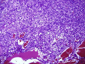Imagen microscópica con magnificación a 100× realizando diagnóstico de carcinoma renal de células claras Fuhrman 3 del riñón izquierdo.