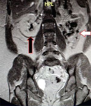 Corte coronal de resonancia magnética abdominopélvica con imagen potenciada en T1 donde se señala con la flecha negra el riñón derecho de configuración normal y con la flecha blanca la ausencia quirúrgica del riñón izquierdo con sitio ocupado por asas intestinales.
